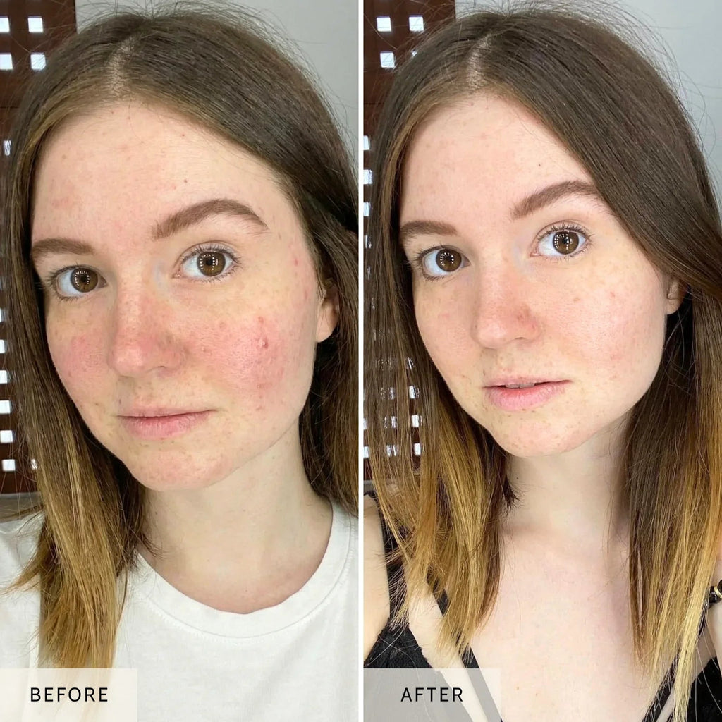 Nicebeam Multi-Wavelength LED & Laser Face Mask