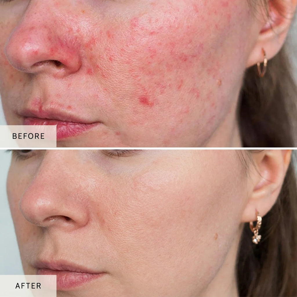 Nicebeam Multi-Wavelength LED & Laser Face Mask